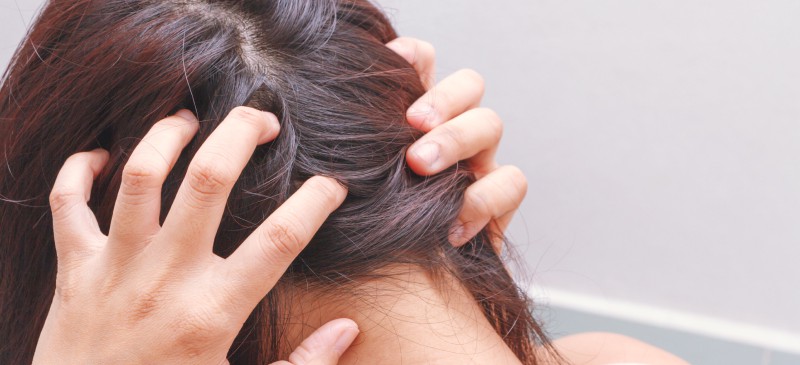 Suffering From Scalp Ringworm (Tinea Capitis): Know Its Treatment &  Prevention