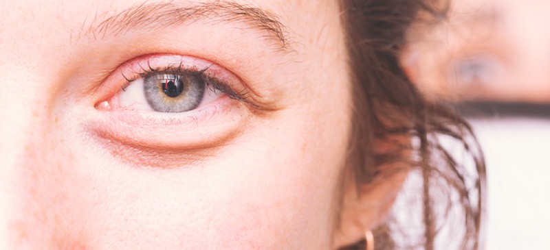 Treat Eye Bags using Light therapy and Lifestyle Changes