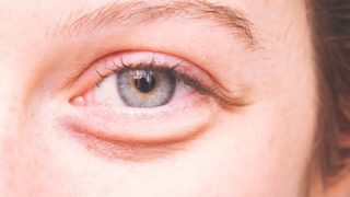 What Causes Under Eye Bags?