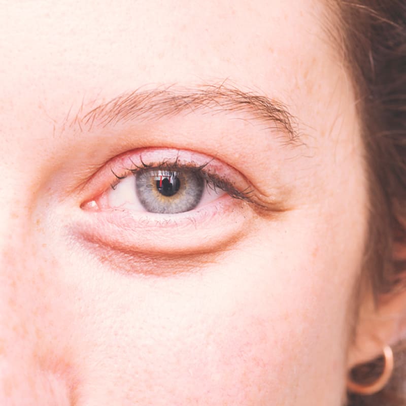 10 Natural Ways To Get Rid Of Bags Under The Eyes