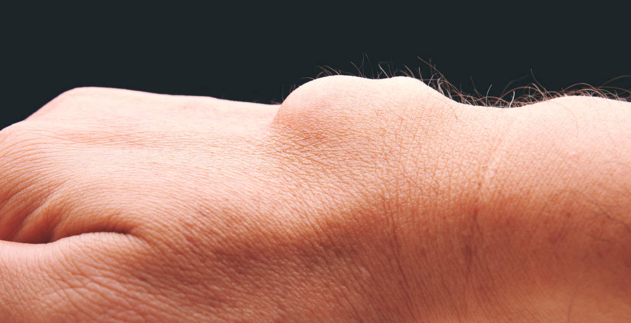 Home remedies for ganglion cyst on wrist