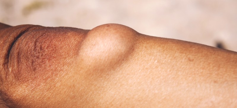 Lumps Under Skin (that Move): Lipomas and Other Causes