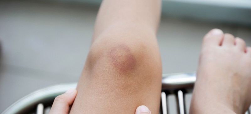 How to get rid of bruises - Dr. Axe