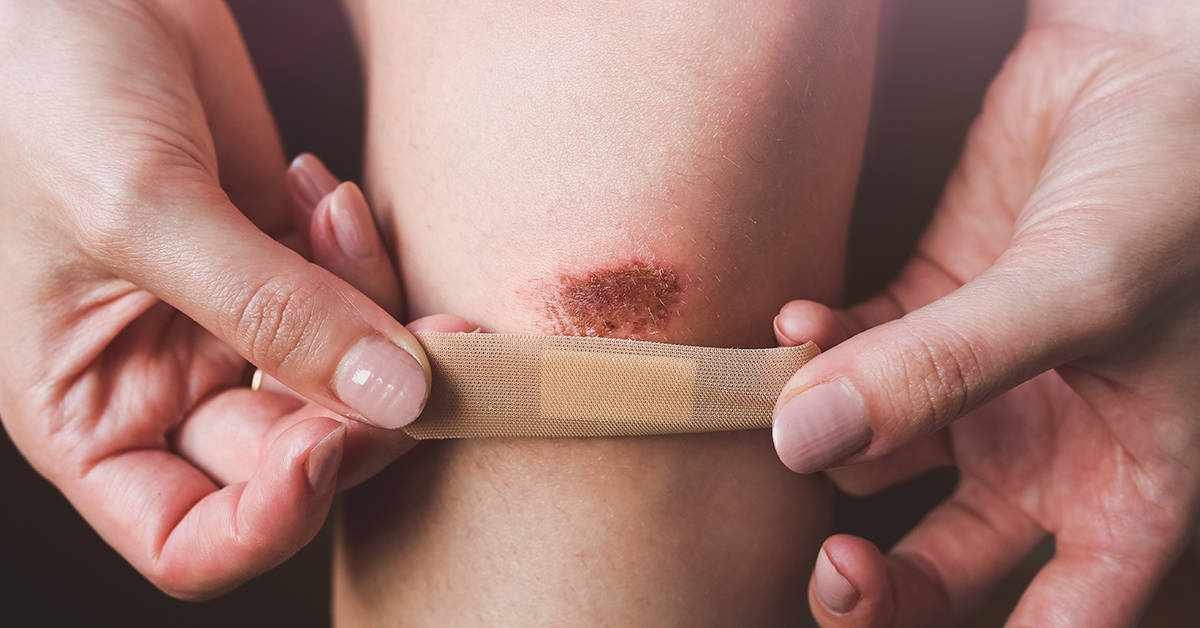 How to Treat Cuts and Scrapes