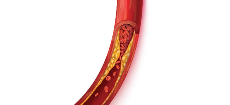 Keto Diet and Cholesterol: Does It Help or Hurt?