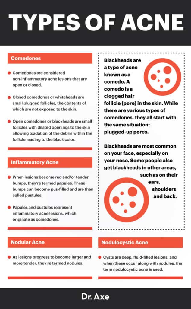 How to Get Rid of Blackheads Blackhead Removal, Diet Tips Dr. Axe