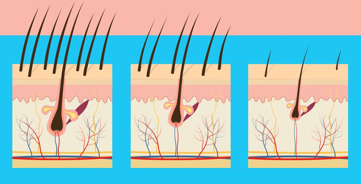 DHT (Dihydrotestosterone): Role in Hair Loss, How to Reduce It