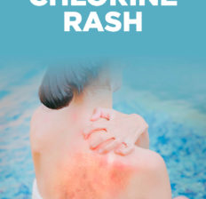 Chlorine rash - Dr. Axe