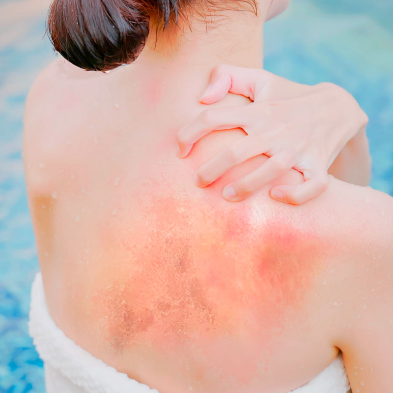 Chlorine Rash And Swimmer's Itch: Cause, Treatment And Prevention