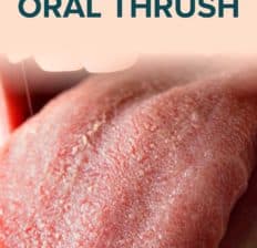 Oral thrush - Dr. Axe