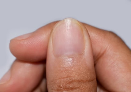 Missing half moons (lunulae)