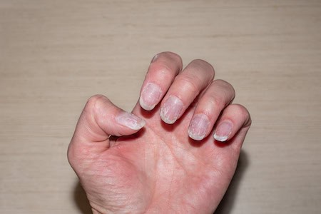 Brittle nails