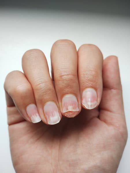 Separated nails