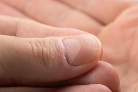 Horizontal ridges (Beau's lines)