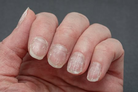 Peeling nails